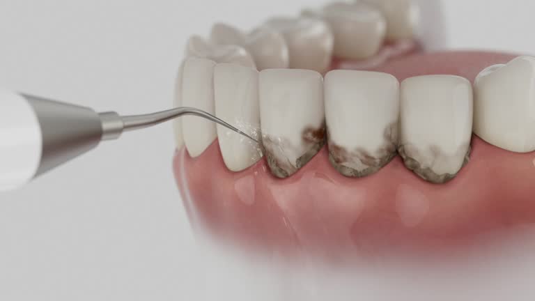 Trusted Wisdom Tooth Removal service in Allentown, PA - Dentist Open Now